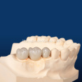 Ang na -customize na dental porselana ay nag -fuse sa metal